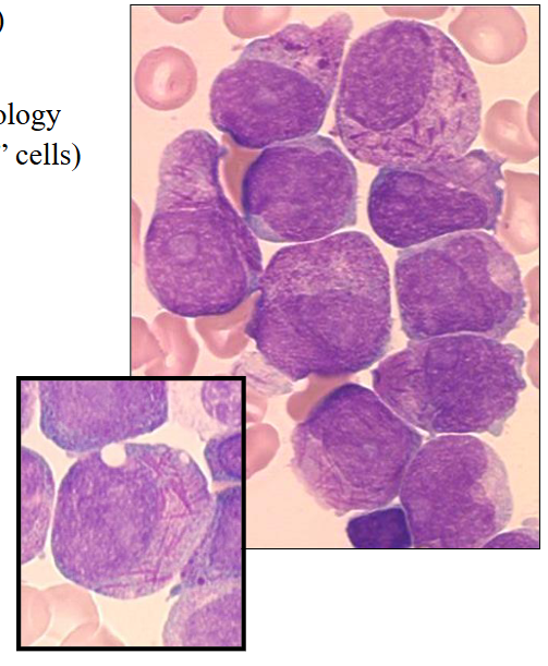 <p>- Age: any (20-60 yrs most common)</p><p>.</p><p>Morphology:</p><p>- Blast cells: promyelocyte morphology</p><p>- Granules and Auer rods ("faggot" cells)</p><p>- CD34-negative; CD33 positive</p><p>.</p><p>Coagulation:</p><p>- DIC; hypofibrinogenaemia</p><p>.</p><p>Genetics:</p><p>- t(15;17) PML:: RARA</p><p>.</p><p>Therapy:</p><p>- All-trans Retinoic acid - Arsenic trioxide</p><p>.</p><p>- Prognosis: Good</p><p>- "faggot" is from old english meaning bundle of sticks</p><p>.</p><p>- the reason that vitamin A (Retinoic acid) worked well is because the genetic abnormality involving chromosomes 15 and 17 involves the retinoic acid receptor gene, and by giving on retinoic acid, we can sometimes overcome the effect of that translocation</p>