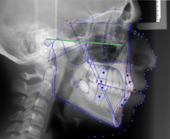 <p>which reference plane:</p><p>- Porion to Orbitale</p><p>- Cranial base reference line</p><p>- "Natural head position"</p><p>- Should be parallel to the floor when the patient "looks off into the horizon"</p>