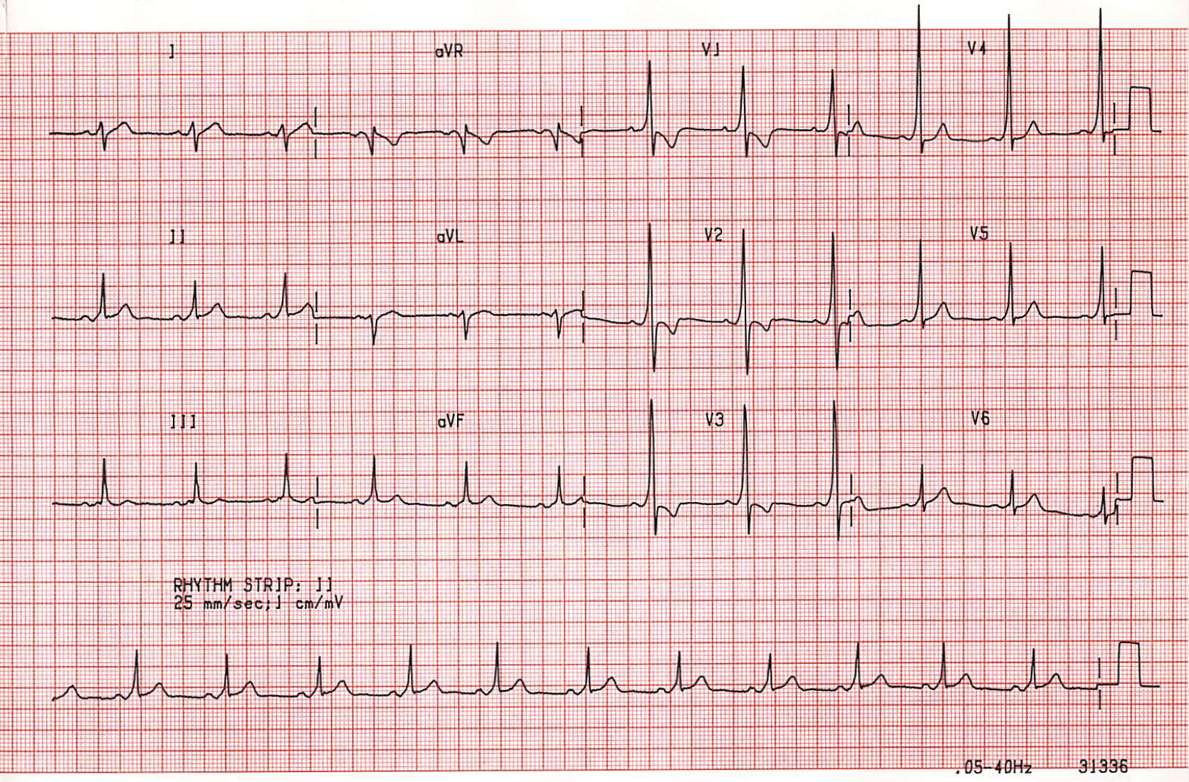 <p>Congenital accessory pathway (Bundle of Kent) with associated SVT</p><p>-Sx: palpitations, dizziness, mild chest pain</p><p>-EKG shows delta wave, short PR interval, and wide QRS</p><p>-Procainamide if stable</p>