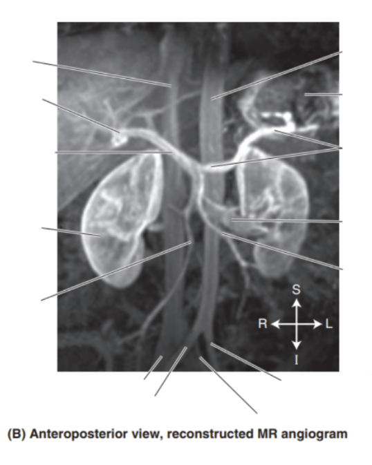 <p>Please label the reconstructed MR angiogram </p>