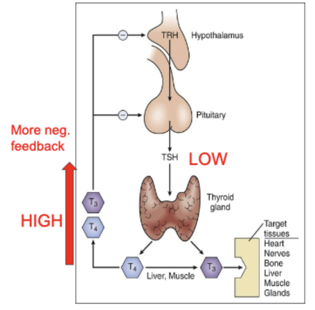 <p>The thyroid gland produces excessive amounts of T<sub>3</sub> and T<sub>4</sub></p><ul><li><p>Bodily reaction (more negative feedback loop): The hypothalamus and pituitary gland recognize there’s an excess of thyroid hormones, and respond by reducing the amount of TRH and TSH produced. However, there is something inherently wrong with the thyroid, which continues to produce thyroid hormones</p></li></ul><p></p>