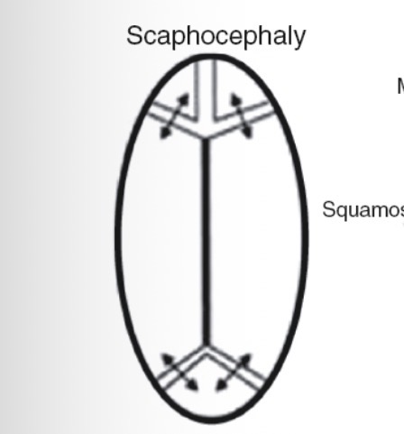 <p>Dolichocephy/spachocephaly (elongated and narrow)</p>