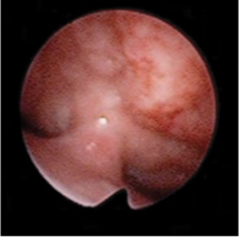 <p>Why is this VPI surgery unsuccessful?</p>