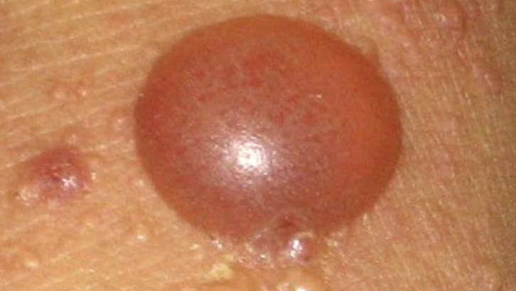 <p>Primary lesion - bulla </p>