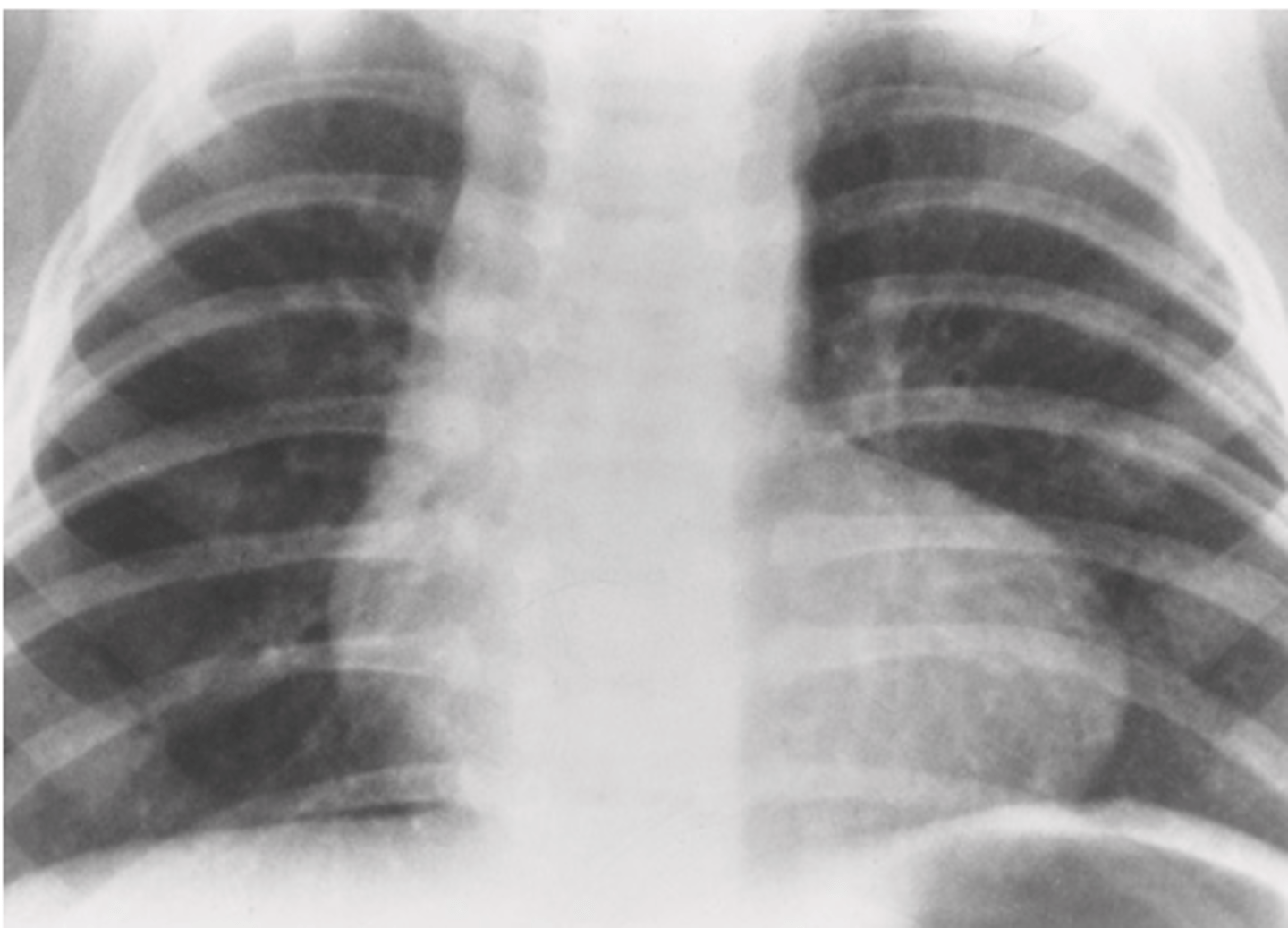 <p>A. Tetralogy of Fallot</p>