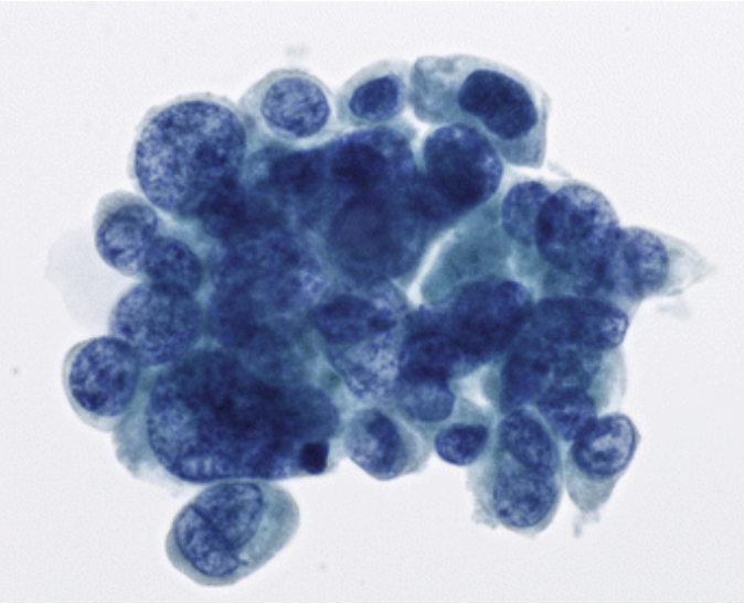 <p>1) Critère obligatoire pour atypies sévères selon critères de Paris (uro) </p><p>2) Conduite si atypies sévères </p>