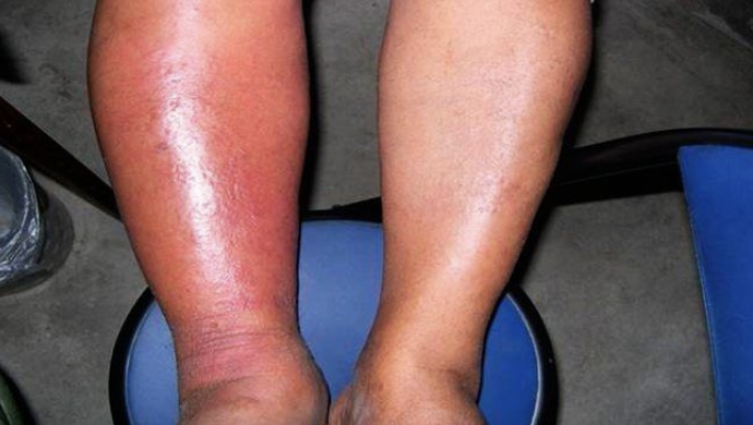 <p>Paciente masculino de 58 años, antecedentes de DM de 3 años de evolución en tratamiento con glibenclamida 5 mg cada 12 horas. Acude por presentar desde hace 4 días dolor leve en miembro pélvico izquierdo asociado a cambio de coloración y aumento de la temperatura local. Al dia previo presenta fiebre 38ºC. Refiere no haber presentado ningún traumatismo. A la exploración usted observa lo que se muestra en la imagen. La lesión no es sobreelevada, se palpa caliente. El diagnostico más probables es:</p>