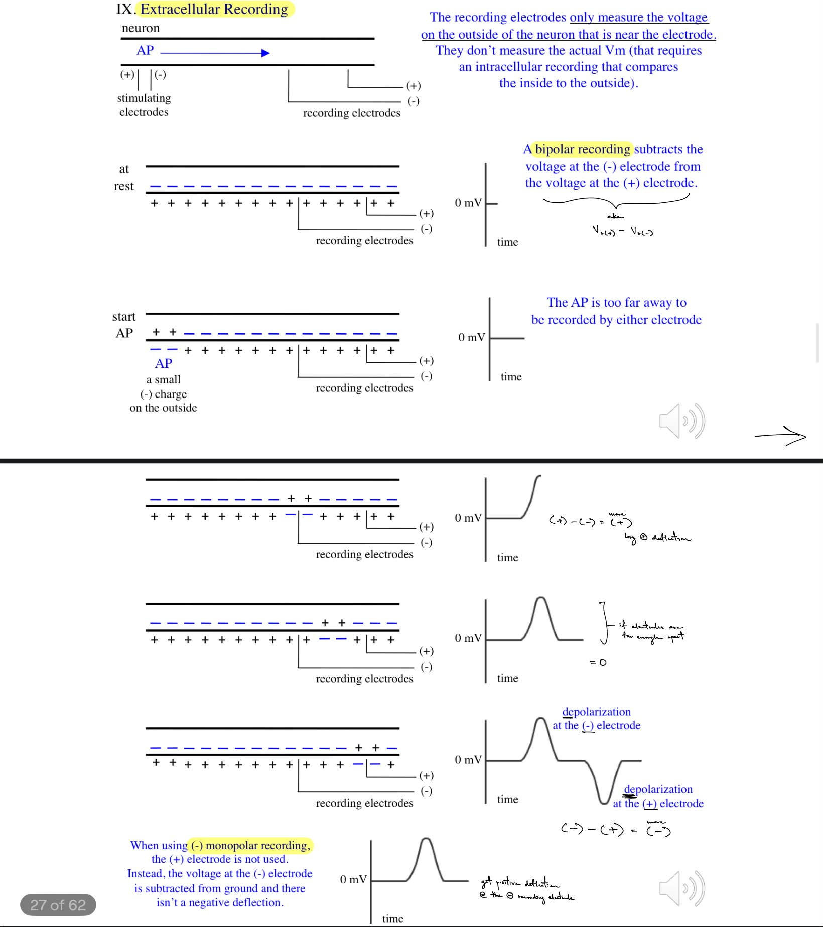 <p>2 stimulating electrodes (+ and -) initiate AP that propagates down the neuron’s axon towards the 2 recording electrodes (+ and -), where the <u>r.e. only measure the voltage on the </u><strong><u>outside </u></strong><u>of the neuron that is near/local to the electrode</u> (meaning they don’t measure the actual Vm which requires intracellular recording)</p><p>_</p><p>get bipolar recording</p><ul><li><p><strong><mark data-color="blue" style="background-color: blue; color: inherit;">V<sub>r(+)</sub> - V<sub>r(-)</sub> </mark></strong><mark data-color="blue" style="background-color: blue; color: inherit;"> </mark>       ← aka voltage at (+) r.e. minus the voltage at (-) r.e.</p></li></ul><p>__</p><p>hits the negative r.e. only → get big positive deflection</p><ul><li><p>(+) - (-) = more +</p></li></ul><p>then in b/w the 2 r.e. → back to 0 mV</p><ul><li><p>0-0 = 0</p></li></ul><p>then hits the positive r.e. only → get a big negative deflection</p><ul><li><p>(-) - (+) = more negative</p></li></ul><p>…</p><ul><li><p>^ so at (-) r.e., depolarization is a <u>positive</u> deflection</p></li><li><p>^ so at (+) r.e., depolarization is a <u>negative</u> deflection</p></li></ul><p></p>
