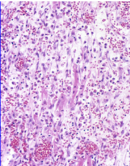 <p>granulation tissue</p>