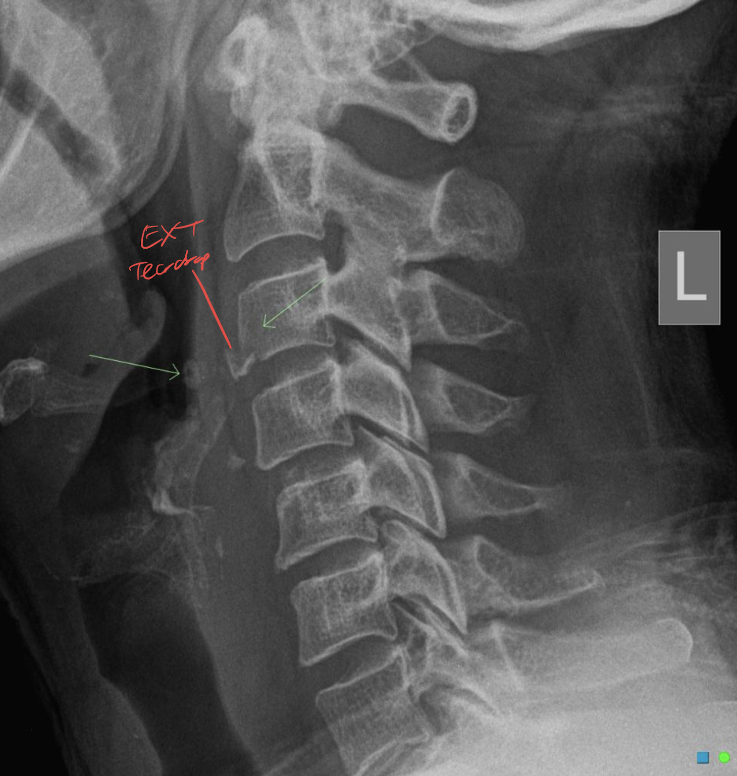 <ul><li><p>Anterior longitudinal ligament pulls fragment away from inferior aspect of vertebra due to sudden hyperextension</p></li><li><p>Causes a displaced anteroinferior bony fragment</p></li><li><p>Common after diving accidents and tends to occur at C2</p></li></ul><p></p>