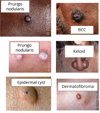 <ul><li><p>Epidermal cysts</p></li><li><p>Basal cell carcinoma</p></li><li><p>Keloid</p></li><li><p>Dermatofibroma</p></li><li><p>Prurigo nodularis</p></li></ul><p></p>