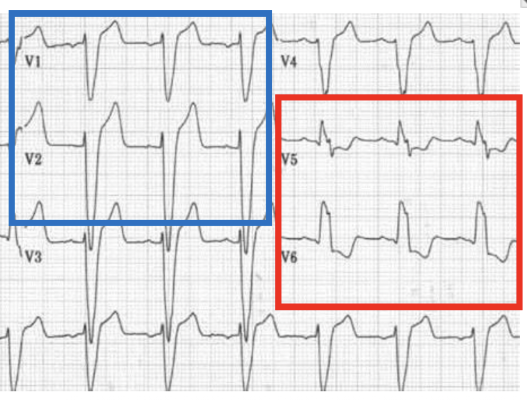 <ul><li><p><span><strong>RSR’ pattern on the left side of the heart → V5 &amp; V6</strong></span><span style="background-color: transparent;"> → broad monomorphic wave, "clumsy" not smooth</span></p></li><li><p><span><strong>Reciprocal<u> Deep S </u>on right side of the heart → V1 &amp; V2</strong></span></p></li></ul><p></p>