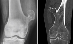 <p>What is this?</p><p>- < 20 yo, Male</p><p>- No pain</p><p>- Diaphyseal - Femur, humerus, tibia, ribs, scapula (anywhere off growth plate)</p>