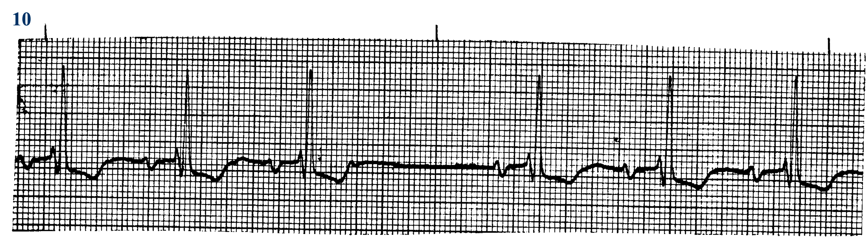 <p>what ECG is this? </p>