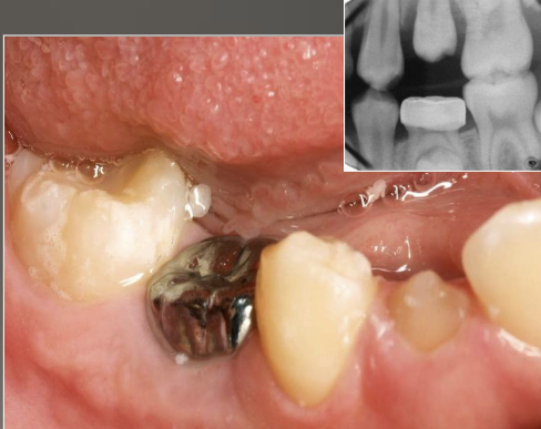 <p>cessation of eruption after emergence, fusion of cementum with bone, unknown pathogenesis </p>