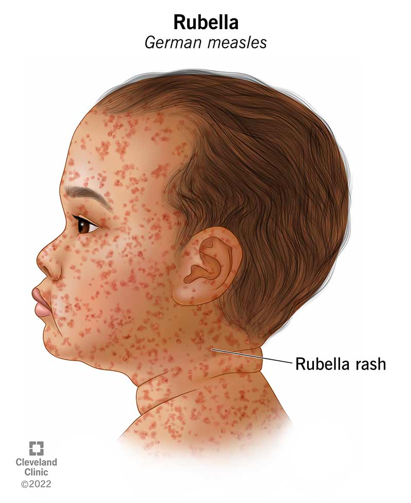 <p>Rubella (German measles)</p>