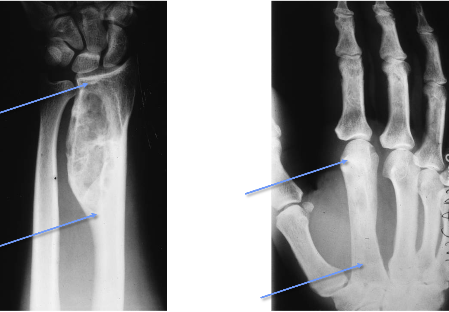 <p>What tumour like disorder is this?</p>