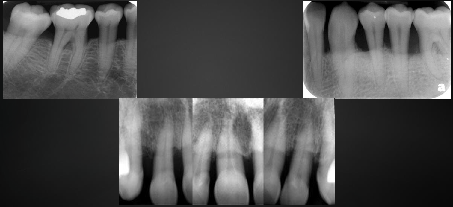 <p>what kind of bone loss is this?</p>