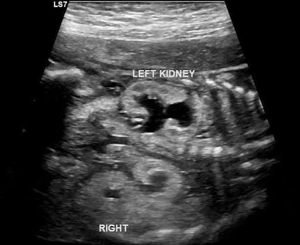 <p>urinary tract obstruction </p><ul><li><p>pelviectasis > 10mm</p></li></ul><p></p>