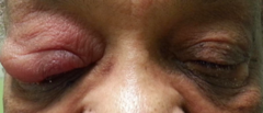 <p>when the lid swells, treat to prevent orbital cellulitis</p><p>oral antibiotic</p>