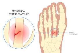 <p>stress fracture</p>