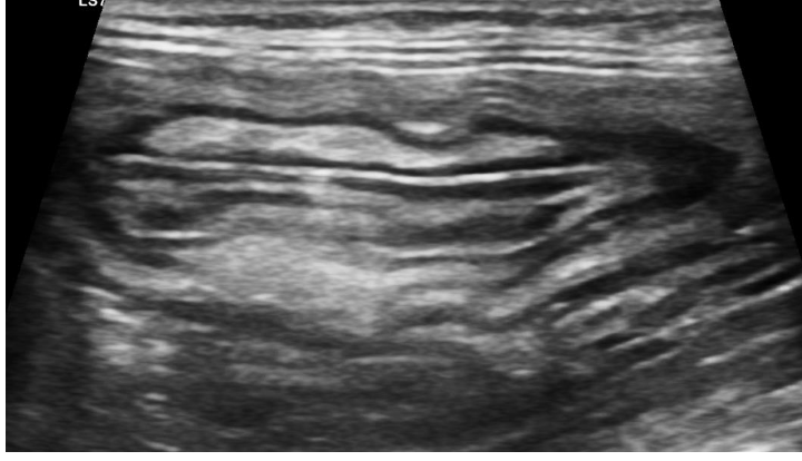 <p>what does the following ultrasound show?</p>