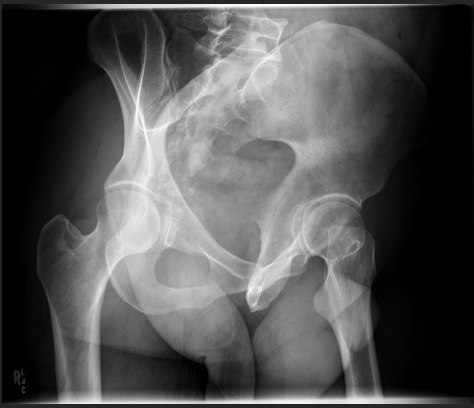 <p>How many degrees is the hip/pt. rotated?</p>