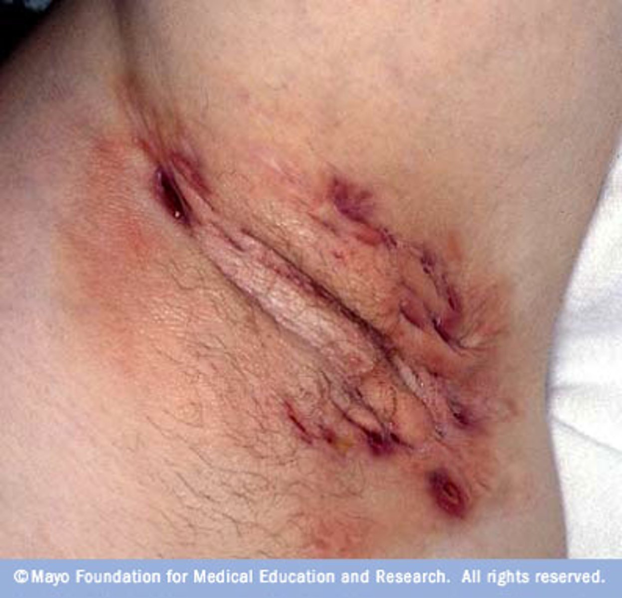 <p>small, painful lumps that form underneath the skin</p>