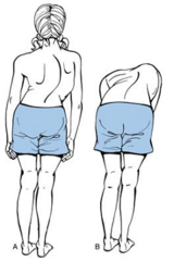 <p>CC: usually ASX</p><p>Frequently reported by caregiver, + screenings</p><p>- poor posture</p><p>- hips sticking out</p><p>- uneven shoulders</p>