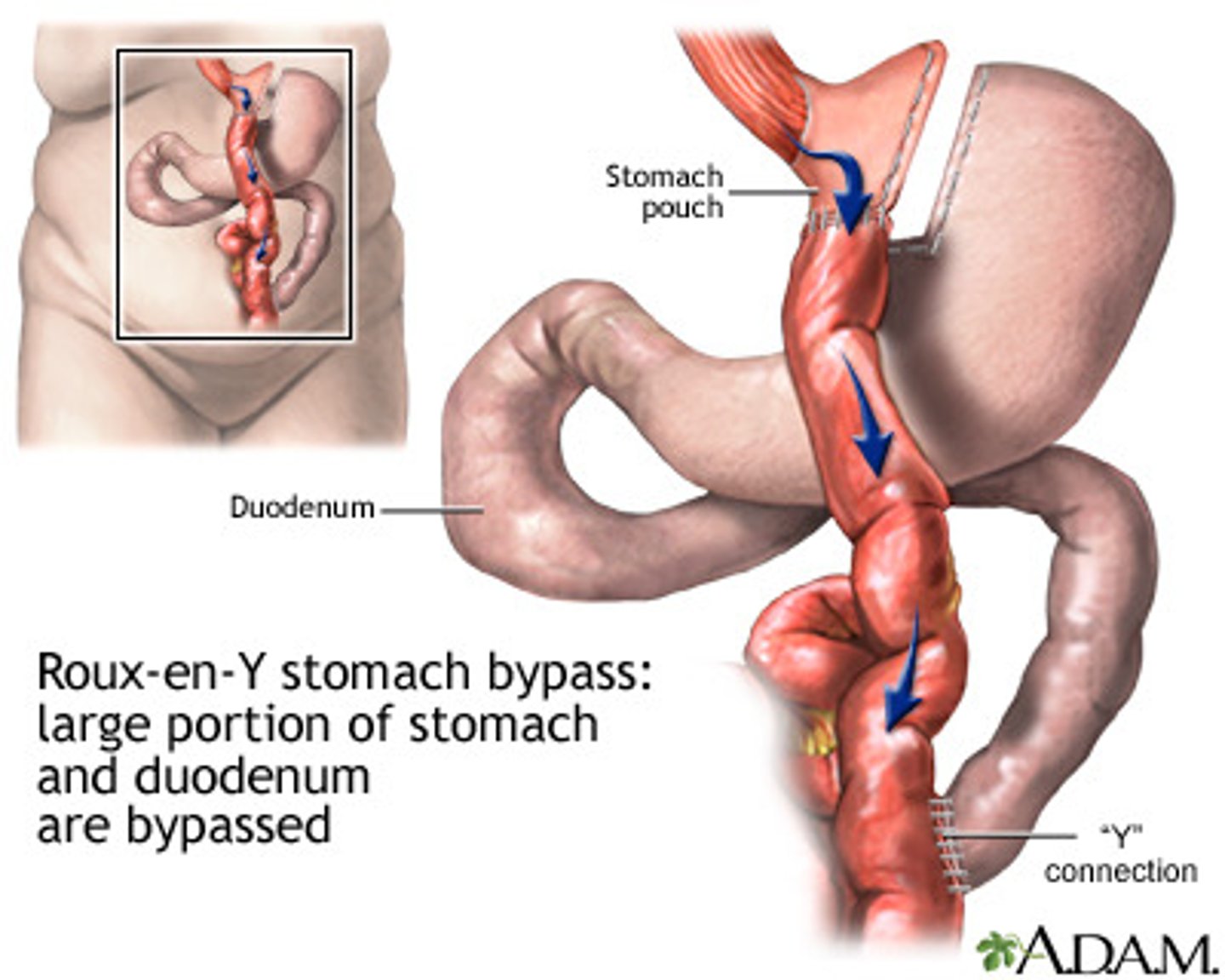 <p>gastrojejunostomy</p>