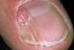 <p>Fibromas of the nail occur in ______% of patients having tuberous sclerosis</p>