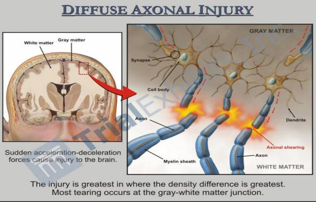 <p><mark data-color="yellow" style="background-color: yellow; color: inherit;">Diffuse axonal injury</mark></p>