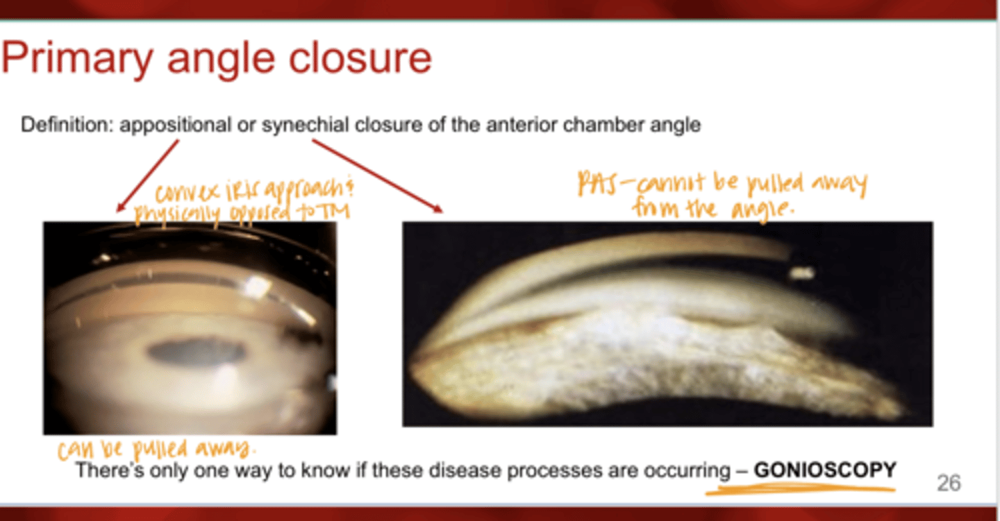 <p>There is only one way to know if primary angle closure or PAS is occurring, what is this?</p>