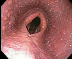 <p>What is your diagnosis:</p><p>a. left laryngeal hemiplegia</p><p>b. right laryngeal hemiplegia</p><p>c. dorsal displacement of the soft palate</p><p>d. pharyngeal collapse</p>