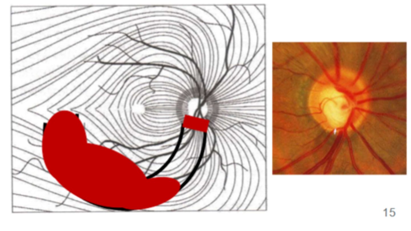<p>as wedge defect expands temporary, the VF near fixation is lost</p>