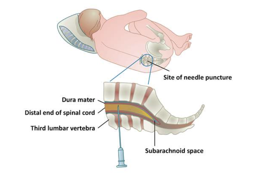<p><span style="line-height: normal;">• </span>A lumbar puncture measures cerebrospinal fluid pressure and helps detect increased intracranial pressure, infection, or bleeding.</p><p class="p1"><span style="line-height: normal;">• </span>Checks for infection of inflammation of CNS or to detect increased intracranial pressure or bleeding</p><p class="p1"><span style="line-height: normal;">• </span>Invasive process; requires insertion of a special needle into the subarachnoid space to collect the cerebrospinal fluid (CSF) for analysis</p>
