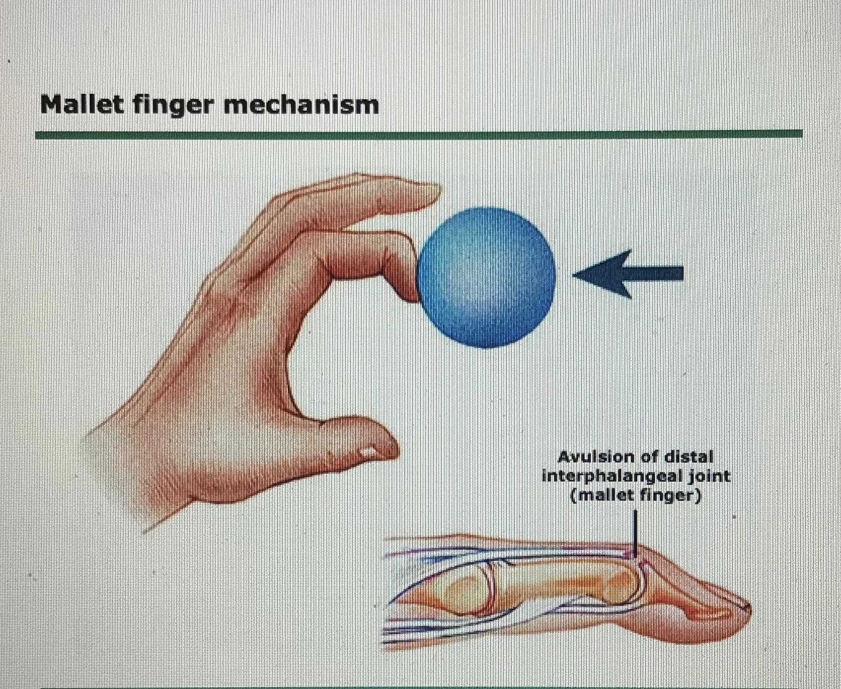 <p>Traumatic Disruption of terminal Extensor tendon leading to inability to extend DIP. Common in baseball and football and resulted due to axial loading at fingertip</p>