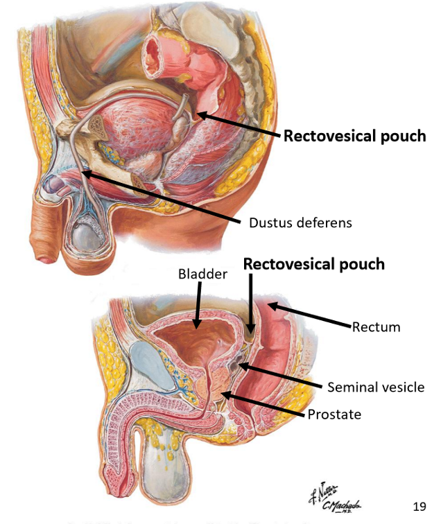 <ul><li><p><strong>Bladder</strong>: anterior to r3ctum</p></li><li><p><strong>R3ctum</strong>: posterior to pelvic organs</p></li><li><p><strong>Prostate</strong>: inferior to bladder + anterior to r3ctum</p></li><li><p><strong>Seminal vesicles</strong>: posterior to bladder</p></li><li><p><strong>Vas deferens</strong>: ascending from scrotum into pelvis via inguinal canal</p></li><li><p><strong>Peritoneum</strong>: reflecting b/w bladder & rectum → <strong>rectovesical pouch </strong>(unique to males, lowest point where fluid could accumulate e.g. due to burst appendix)</p></li></ul><p></p>