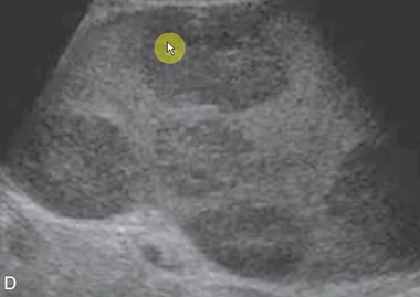 <p>What is the most common malignancy involving the spleen?</p>