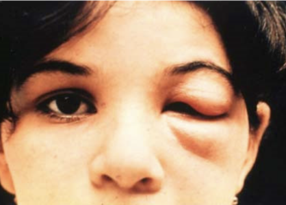 <ul><li><p>Romona’s sign (edema and inflammation from trypomastigotes fecating on host and rubbed into eye)</p></li><li><p>Dogs → acute dz</p><ul><li><p>Lymphadenopathy</p></li><li><p>Myocarditis, tachycardia </p></li><li><p>Pale MM → anemia!</p></li><li><p>Splenomegaly</p></li></ul></li></ul><p></p>