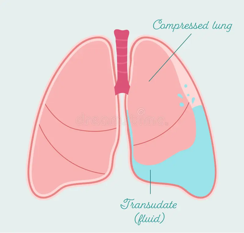 <p>What is <strong>transudate</strong>?</p>