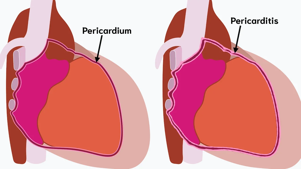 <p>Pericarditis</p>