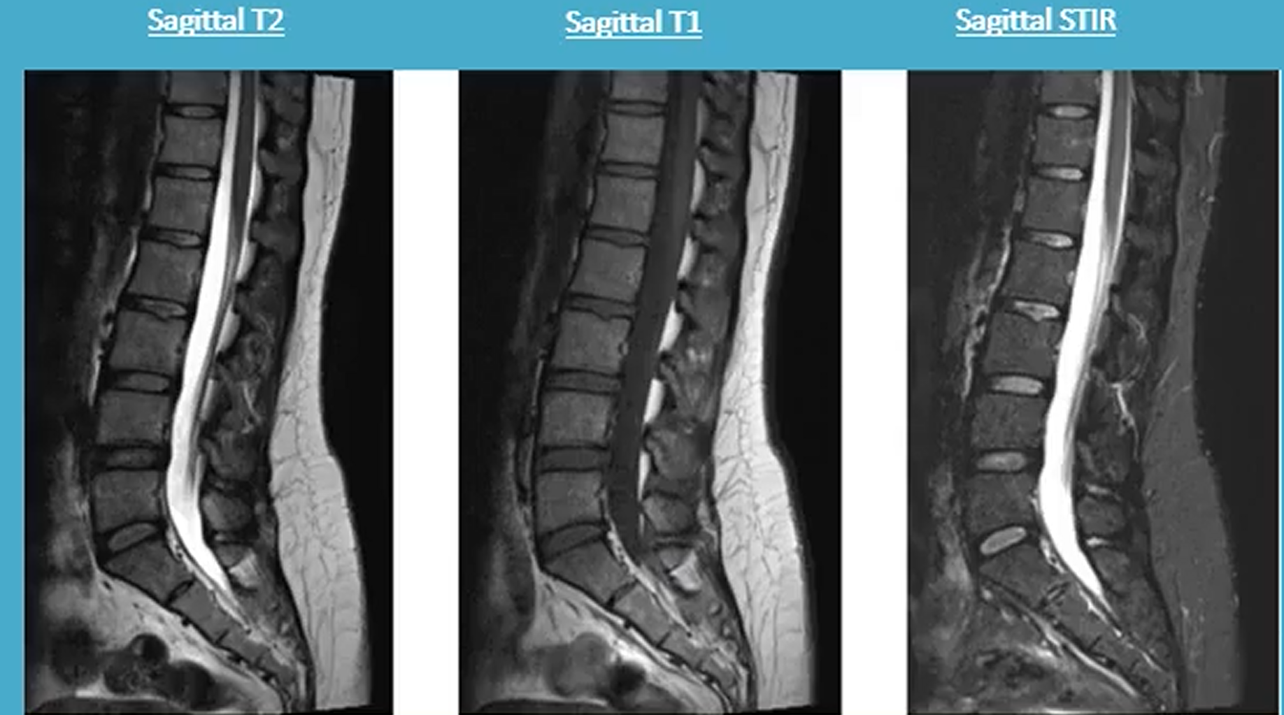 <p>L-spine</p>