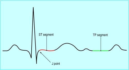 <p>sixth interval</p><p>Time during which ventricles are relaxing and filling  → post-repolarization and then flat line indicating leftover 20% pump of blood</p>