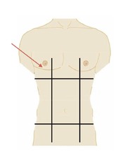 <p>to the right and left of the epigastric region</p>