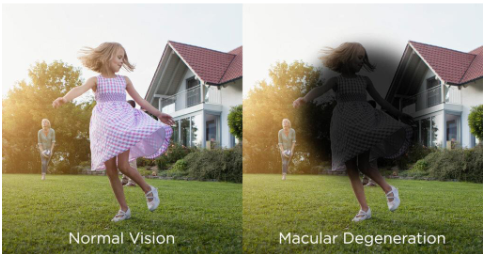 <p>loss of central vision </p>