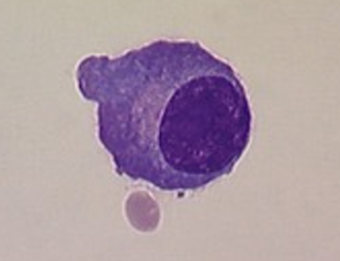 <p><strong><u>Predominant Cells in CSF</u></strong></p><ul><li><p>found in <span style="color: red;">multiple sclerosis</span></p></li><li><p>due to<span style="color: yellow;"> lymphocyte reactions</span></p></li></ul><p></p>
