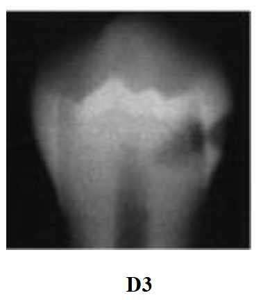 <p>Radiolucency in the inner third of dentin</p>