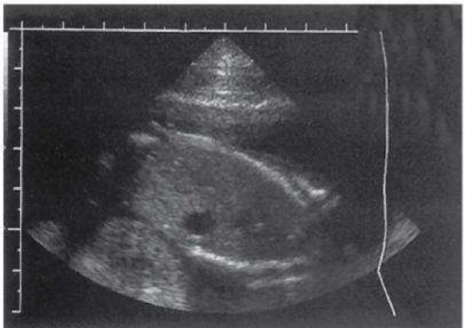 <p>Size of stomach is variable and depends on amount of amniotic fluid swallowed by fetus; appears as anechoic structure on left side of fetal abdomen</p>