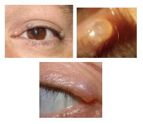 <p>What is the most likely diagnosis ?</p>